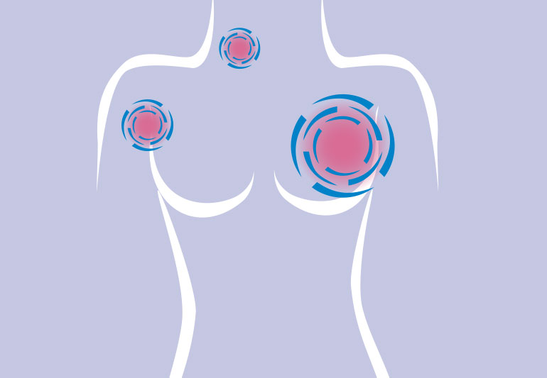 All you need to know about Breast Cancer