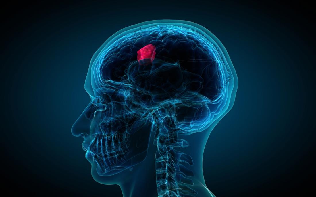 Brain tumor can strike at any age, be observant
