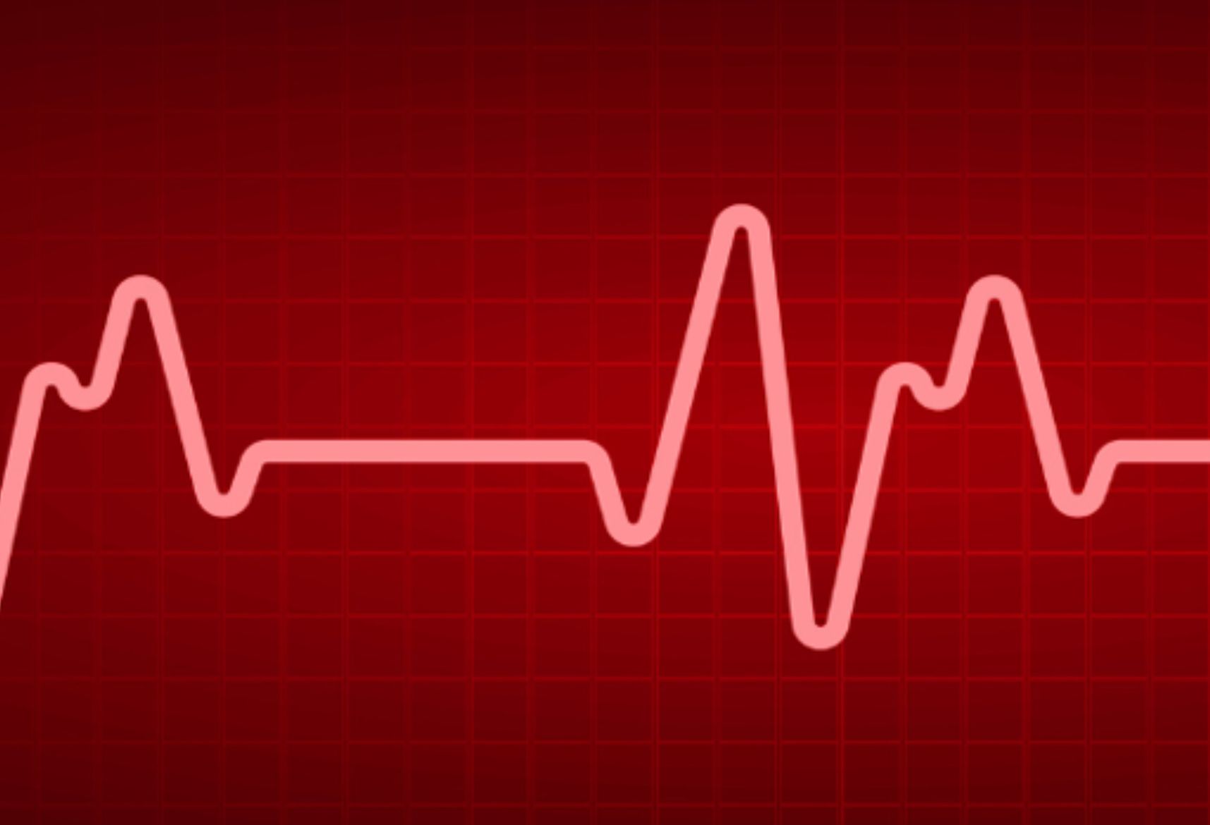 When the Heart’s Rhythm Goes Off Track:Understanding Pulsed Field Ablation